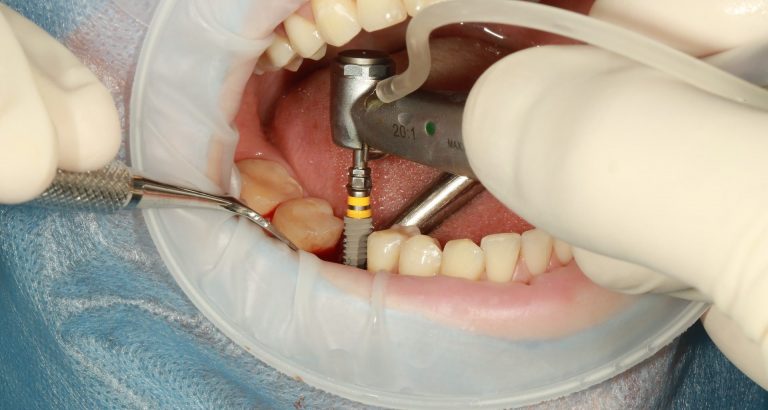 Do You Understand The Risks Of Dental Implants?